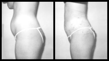 Lower Abdominal Liposuction