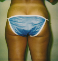Hip, Outer and Inner Thigh Liposuction Female - Before