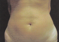 Upper and Lower Abdominal Liposuction Female - Before