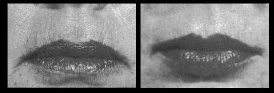 Laser and Lip Augmentation