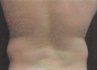 Male Back Liposuction - Before