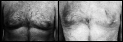 Male Breasts Liposuction