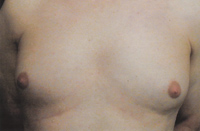 Male Breast Liposuction Male - Before