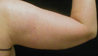 Arm Liposuction Female - Before