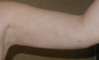 Arm Liposuction Female - Next Day