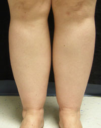 Calves Liposuction Female - Before