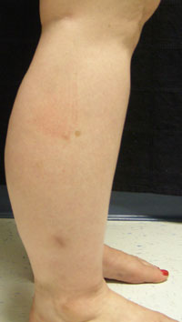 Calves Liposuction Female - Before