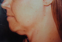 Chin Lift Female - Before
