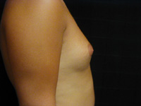 Male Breast Liposuction Male - Before