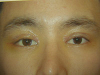 Upper Lower Eyelid Male - 4 Days Later