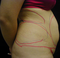 Upper and Lower Abdominal and Hip Liposuction Female - Before
