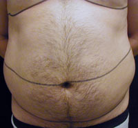 Upper and Lower Abdominal Liposuction Male - Before