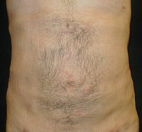 Upper and Lower Abdominal Liposuction Male - Next Day
