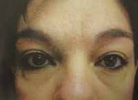 Upper Lower Eyelid female - Before