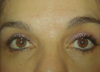 Upper Lower Eyelid Female - 6 Weeks Later