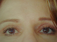 Upper Lower Eyelid Female - 2 Weeks Later