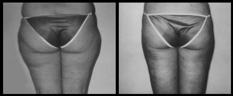Female Outer Thigh Liposuction