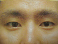 Upper Lower Eyelid Male - Before